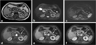 Pancreatic Leiomyosarcoma With Schistosomiasis Hematobia: A Case Report and Literature Review